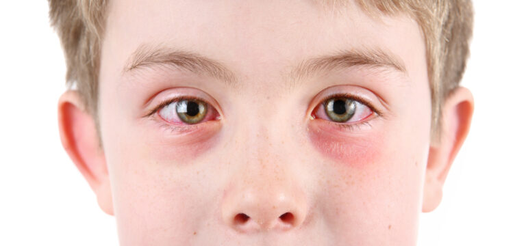Boy,With,Conjunctivitis Boy,With,Conjunctivitis
