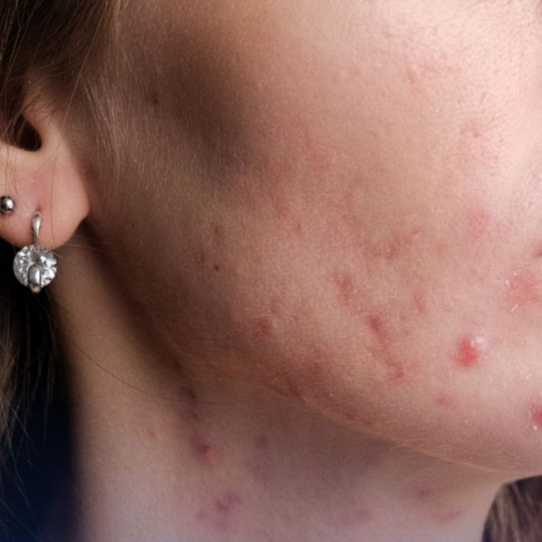 akne u odrasloj dobi