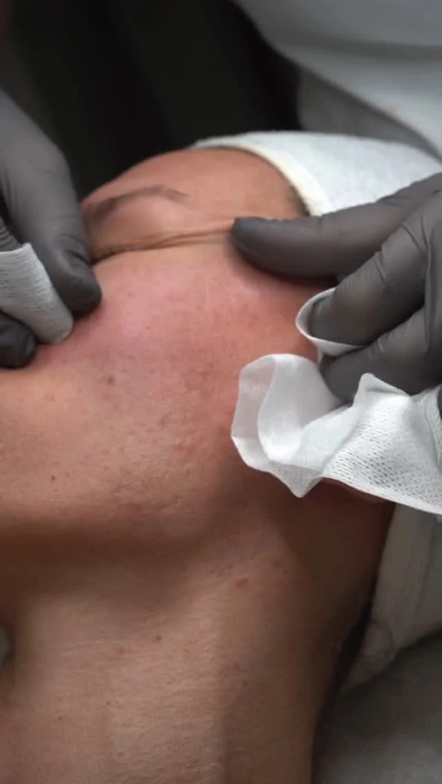 Mislili ste da uz redovitu upotrebu skincare kozmetike nema potrebe za čišcenjem lica?

Netočno! Evo i zašto...:

Vaša koža svakodnevno prolazi kroz brojne izazove – od zagađenja, šminke, do prirodnih ulja. Redovito čišćenje lica nije samo korak u rutini, već ključ zdravog i blistavog tena! 

Smanjuje akne: Čišćenje uklanja nečistoće koje mogu začepiti pore i izazvati akne. 

Stvara savršenu podlogu: Čista koža bolje upija SPF i hidratantne kreme, čime se osigurava zaštita i hidratacija. 

Idealno za šminku: Na zdravoj koži šminka izgleda prirodno, ravnomjerno i traje dulje. 

Podržava zdravu regeneraciju: Čista koža bolje upija hranjive sastojke iz proizvoda za njegu. 

Sprječava proširene pore i upale: Čistoća smanjuje rizik od crvenila i proširenih pora. 

Ne zaboravite, redovito čišćenje lica vodi do dugoročne ljepote i samopouzdanja! 🪞

#ljepotabezfiltera #zdravakoza #kozabezakni #njegalica #savrsenapodloga #volimsvojukozu